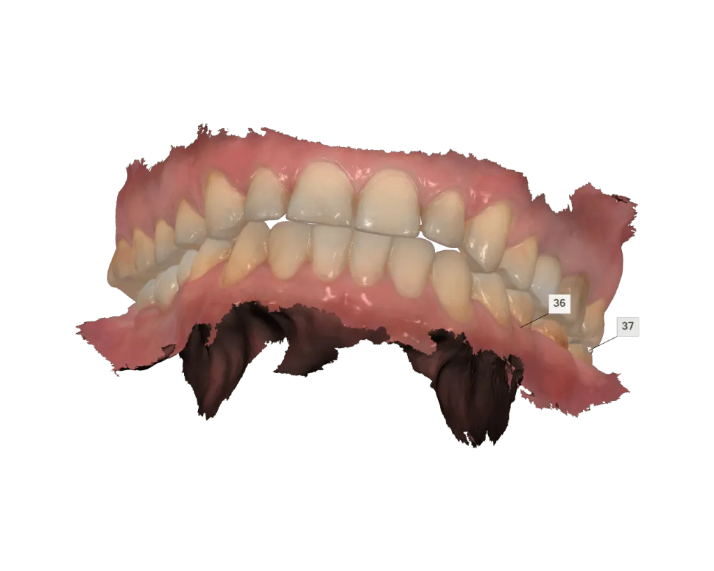 digital dental veneers