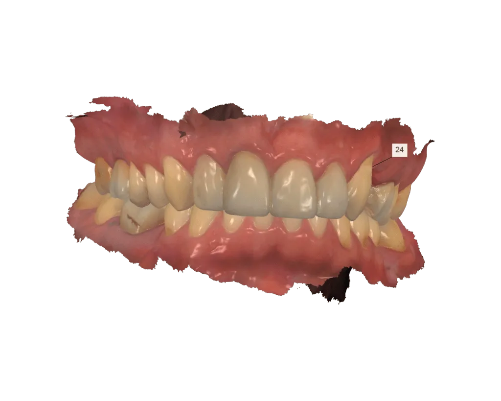 Prótesis Dental Sobre Implantes