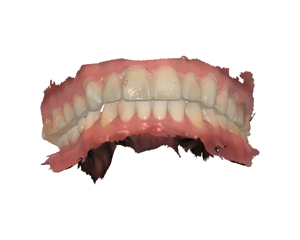 scan of digital dental veneer mock-up