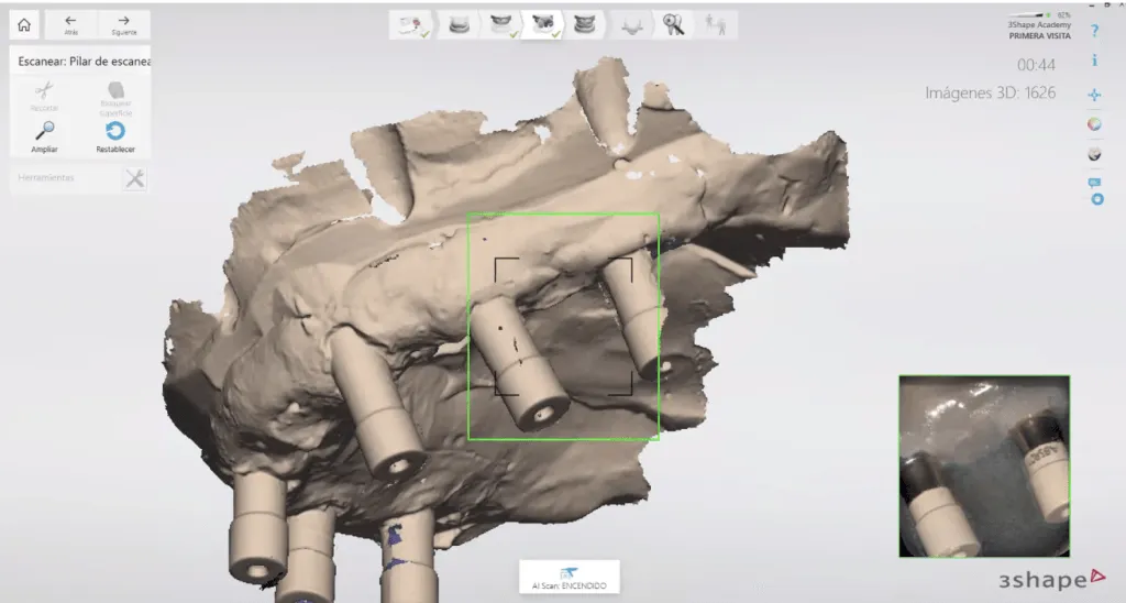 scan body scan Digital Dental Lab