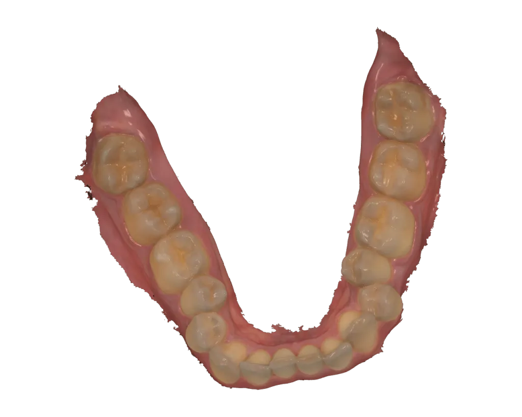 3D bruxism splint lower scan.