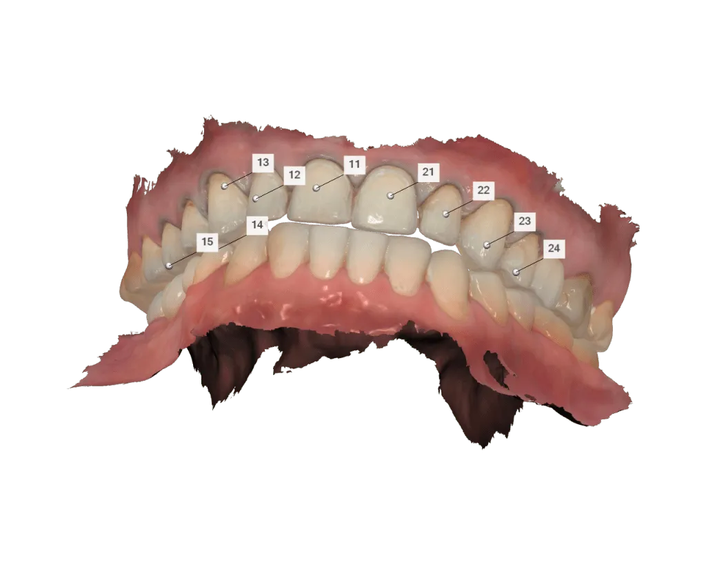 scan of dental veneer preparations