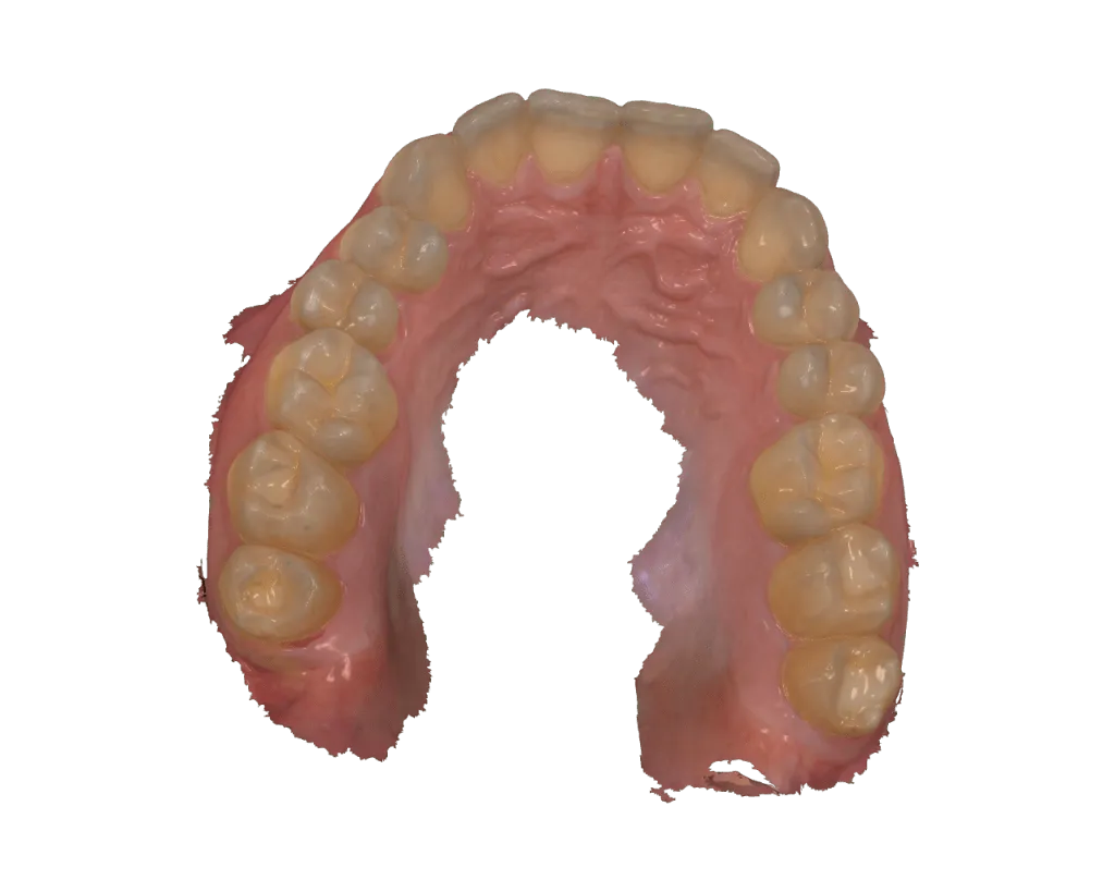 The 3D Occlusal Splint: Splint