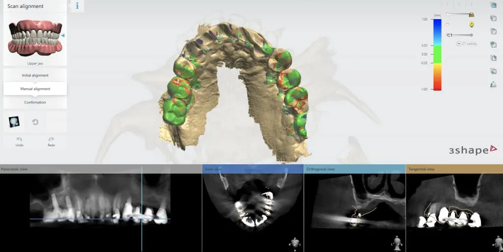 3D surgical guides