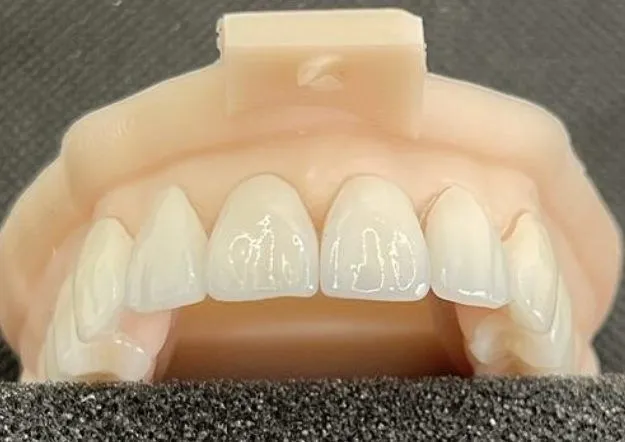 3d model for veneers