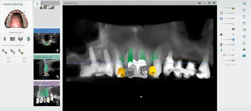 3D surgical guides