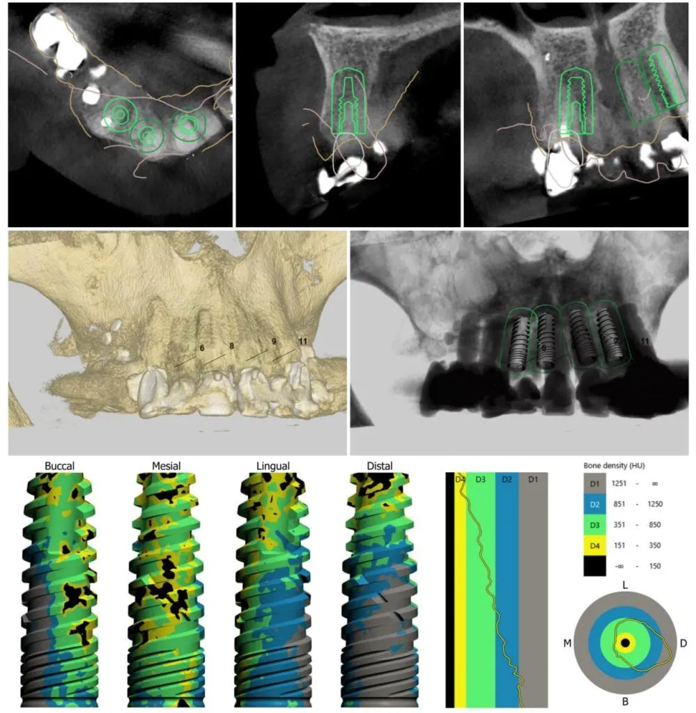 3D surgical guides