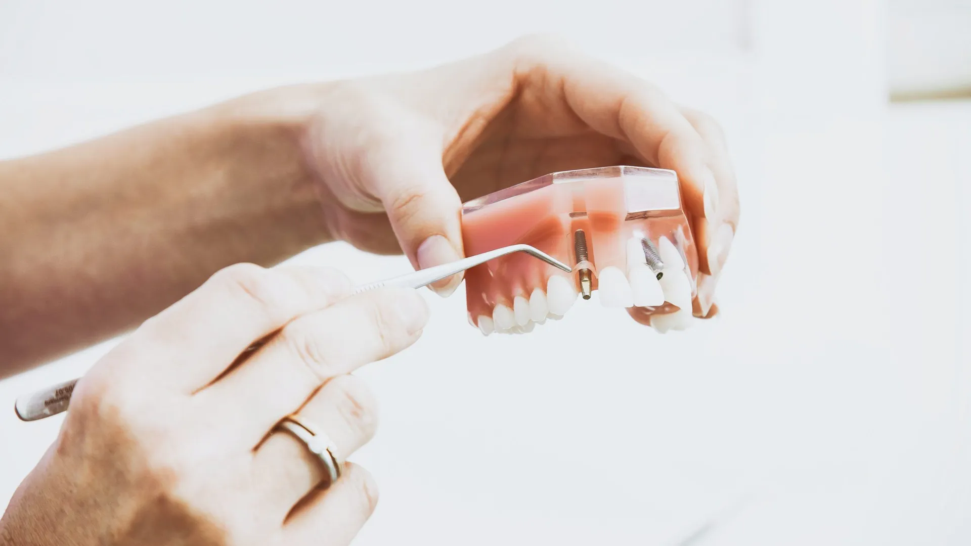 Prótese fixa sobre implantes fabricada com protocolo digital