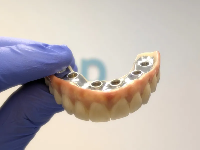 Prótese fixa sobre implantes aparafusadas fabricada com CAD-CAM